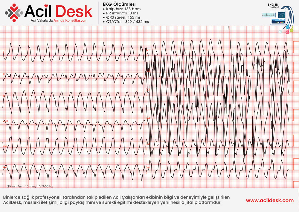 Başvuru EKG'si